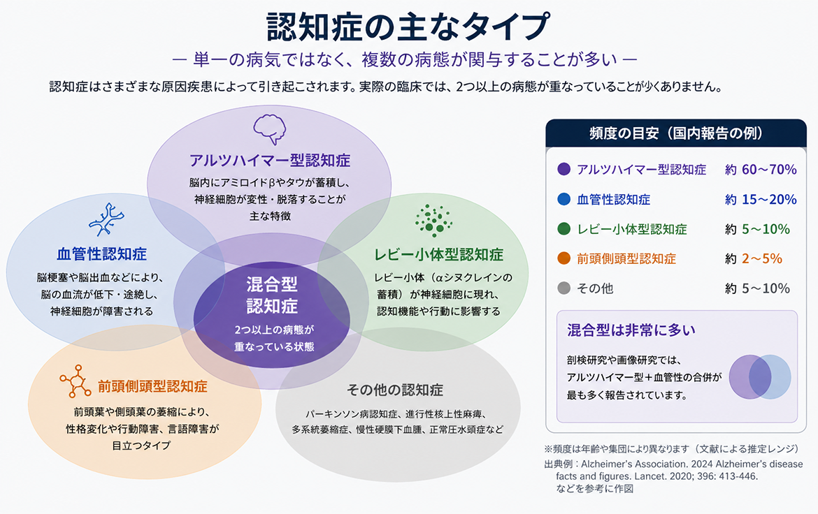 認知症の主なタイプを表した画像